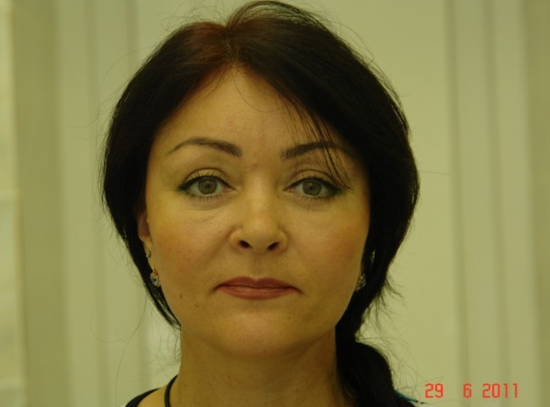 Тотальный лифтинг лица: эндоскопия лба, средней зоны лица, блефаропластика нижних век, СМАС-лифтинг лица, платизмопластика - После (Анфас)