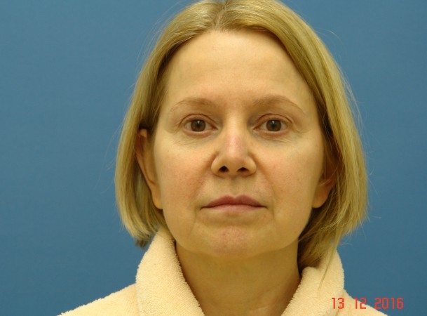 Эндоскопический лифтинг лба, блефаропластика нижних век, СМАС-лифтинг лица, липосакция подбородка - До (Анфас)