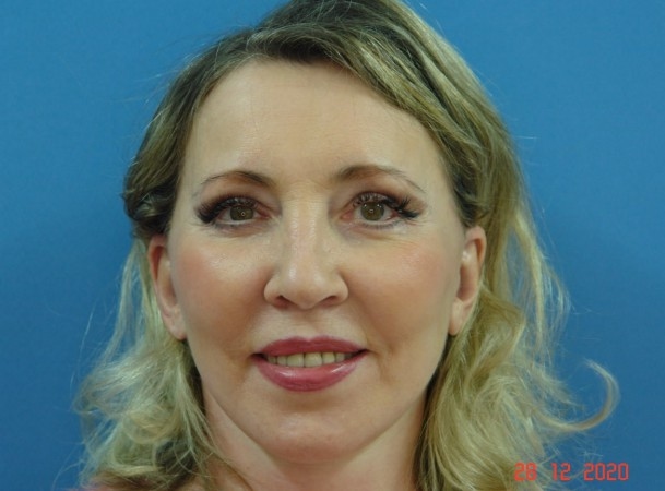 Эндоскопический лифтинг лба, блефаропластика нижних век, СМАС-лифтинг лица, липосакция подбородка, удаление комков Биша - После (Анфас)
