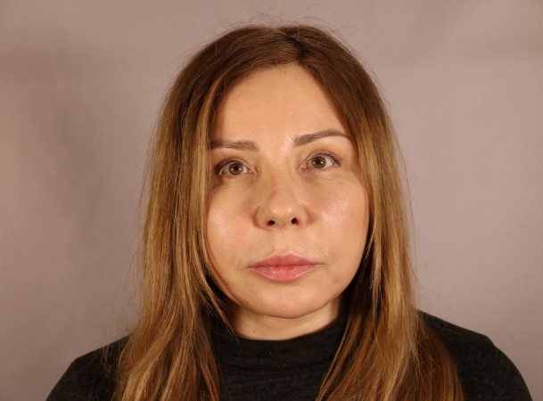 Эндоскопический лифтинг лба, СМАС-лифтинг, Платизмопластика - После (Анфас)