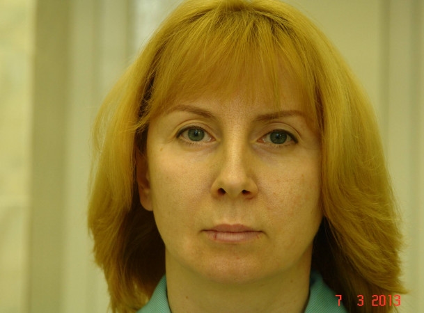 Эндоскопический лифтинг лба, Блефаропластика нижних век, СМАС-лифтинг, Платизмопластика - До (Анфас)
