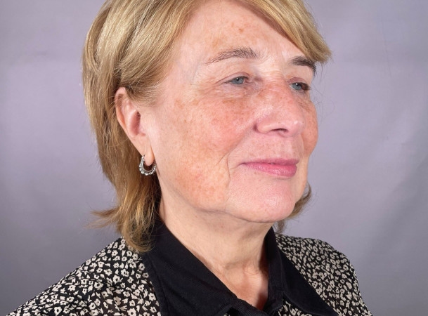 Тотальная подтяжка лица - До (threeQuarterView)