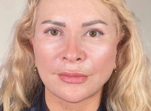 Смас-лифтинг, Платизмопластика - После (Анфас)