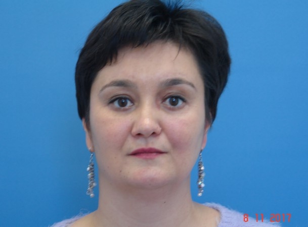 Эндоскопический лифтинг лба, эндоскопический лифтинг средней зоны лица, блефаропластика нижних век - После (Анфас)