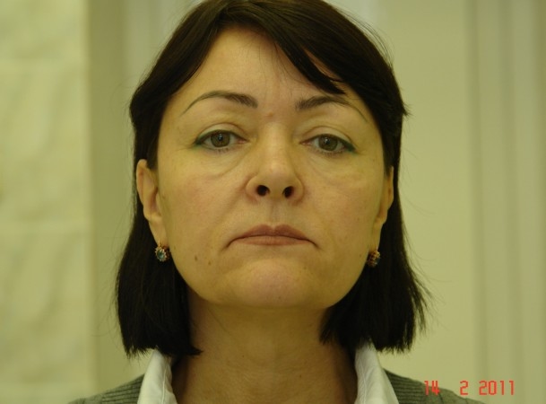 Тотальный лифтинг лица: эндоскопия лба, средней зоны лица, блефаропластика нижних век, СМАС-лифтинг лица, платизмопластика - До (Анфас)