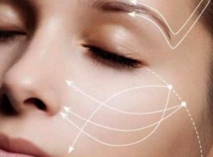 Мезонити для подтяжки лица