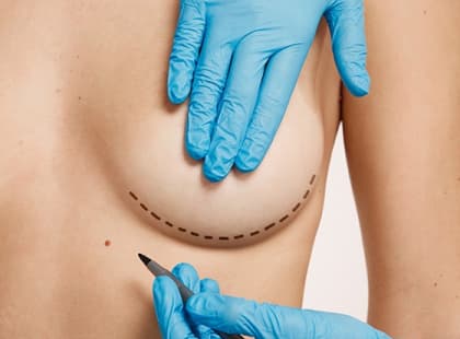 Маммопластика