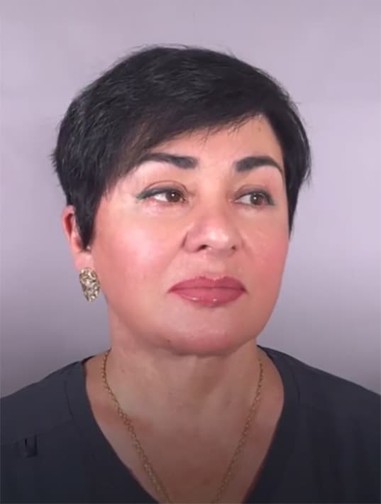 Темпоропластика, Блефаропластика нижних век, Эндоскопическая подтяжка средней зоны лица, СМАС-лифтинг, Платизмопластика - Видео превью