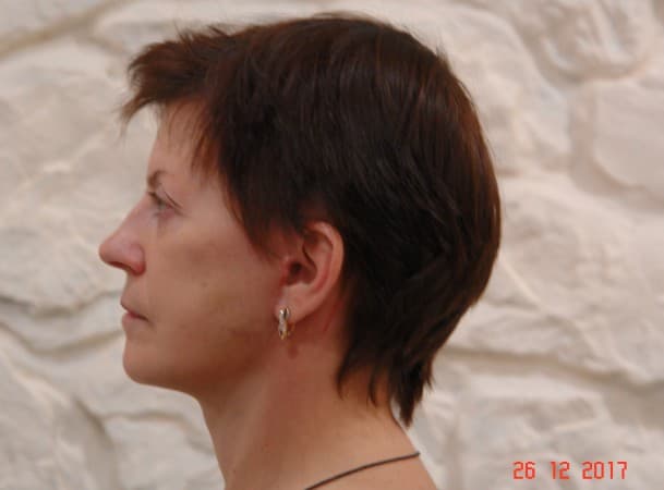 СМАС-лифтинг лица, Липосакция подбородка - после