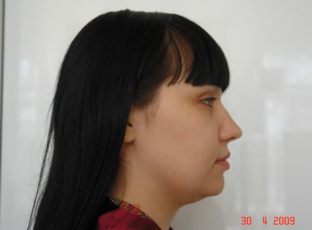 Липосакция подбородка - до