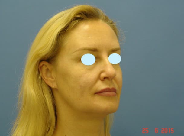 Тотальный лифтинг лица - До (Анфас)