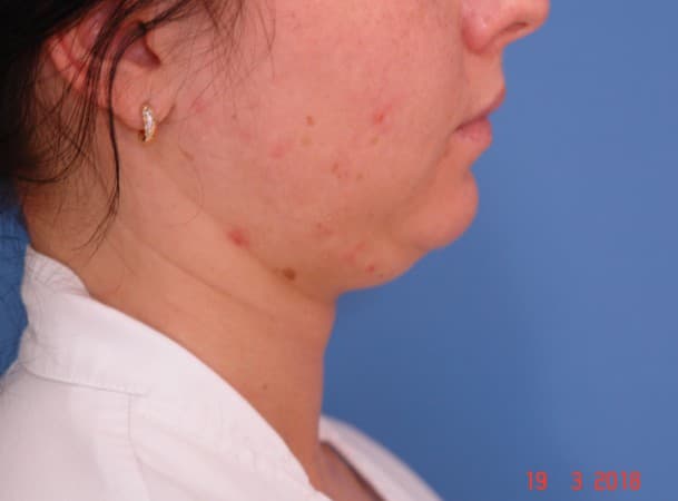 Липосакция подбородка - до