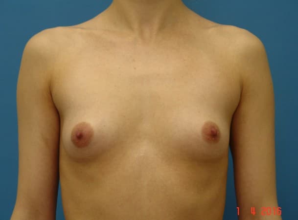Эндоскопическое увеличение груди - до