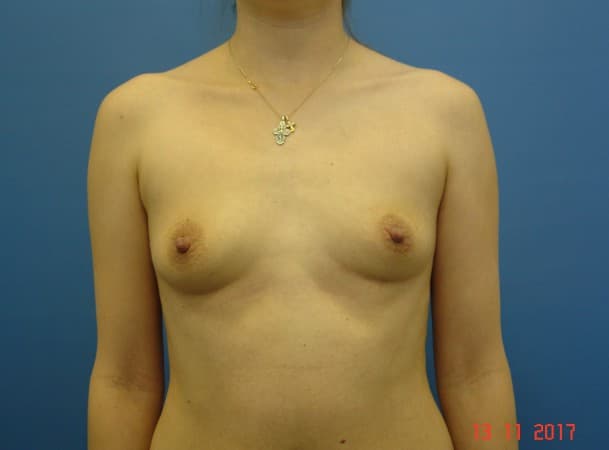 Периареолярное увеличение груди - до