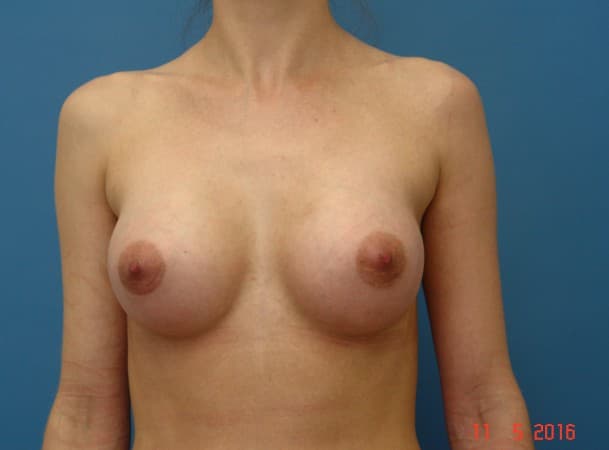 Эндоскопическое увеличение груди - после