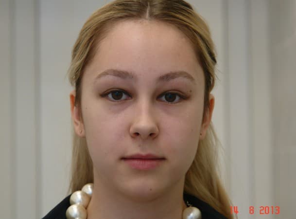 Эндоскопический лифтинг лба - после