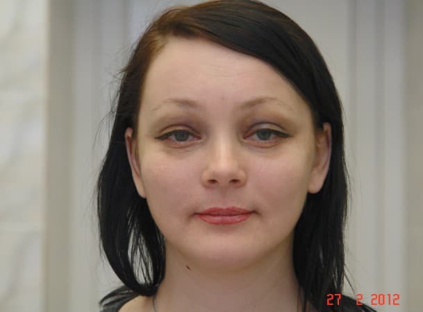 Эндоскопический лифтинг лба, средней зоны лица, блефаропластика - После (Анфас)