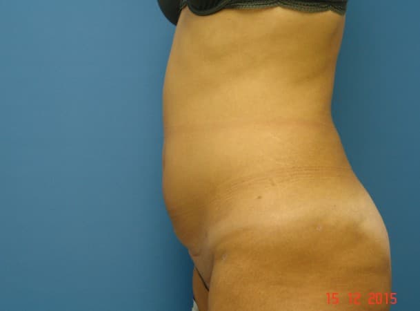 Липосакция живота - После (Анфас)
