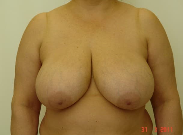 Уменьшение груди - до