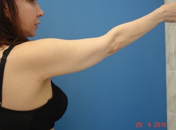 Липосакция рук - После (Сзади)