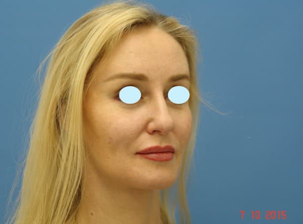 Тотальный лифтинг лица - после