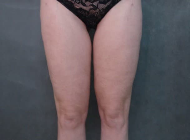 Липосакция колен, наружных бедер, липофилинг ягодиц - после