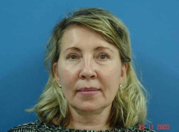 Эндоскопический лифтинг лба, блефаропластика нижних век, СМАС-лифтинг лица, липосакция подбородка, удаление комков Биша - до