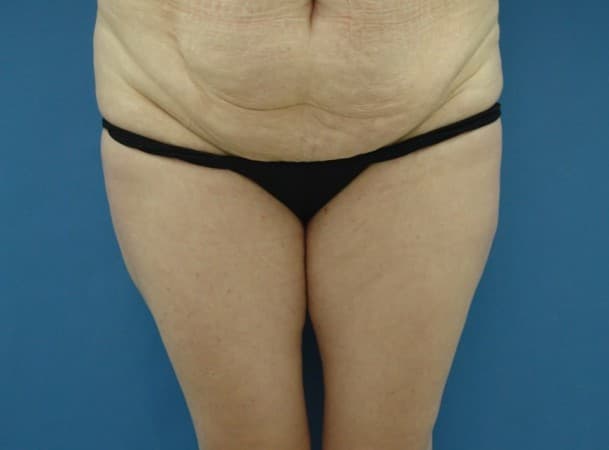 Абдоминопластика - до