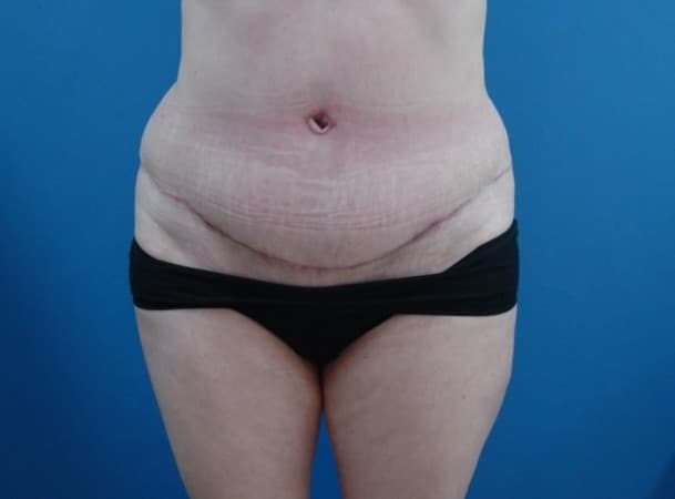 Абдоминопластика - после