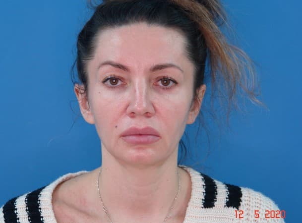 Тотальный лифтинг лица - до