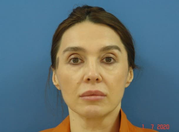 Тотальный лифтинг лица - до