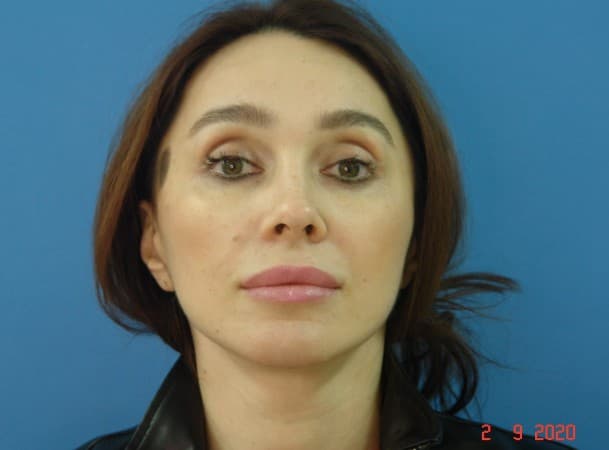 Тотальный лифтинг лица - после