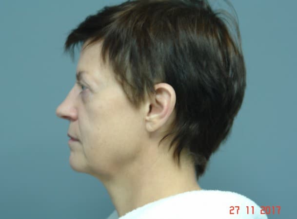 СМАС-лифтинг лица, Липосакция подбородка - До (Анфас)