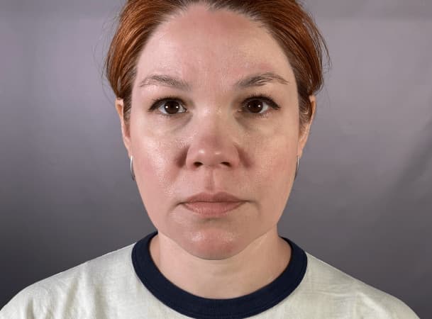 Эндоскопический лифтинг лба, Средняя зона через внутриротовой доступ, Блефаропластика Нижних век с перераспределением жировых пакетов - до