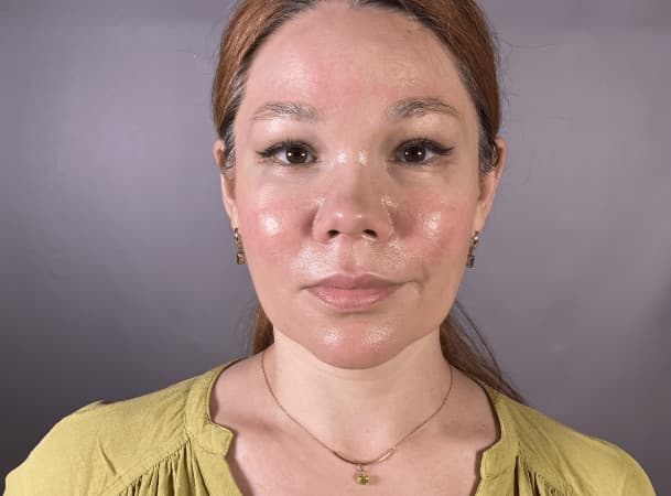 Эндоскопический лифтинг лба, Средняя зона через внутриротовой доступ, Блефаропластика Нижних век с перераспределением жировых пакетов - после