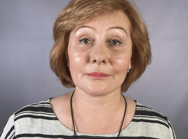 Эндоскопический лифтинг лба, Блефаропластика верхних век, Блефаропластика нижних век,  Эндоскопическая подтяжка средней зоны, СМАС-лифтинг, Липосакция подбородка и брылей - после