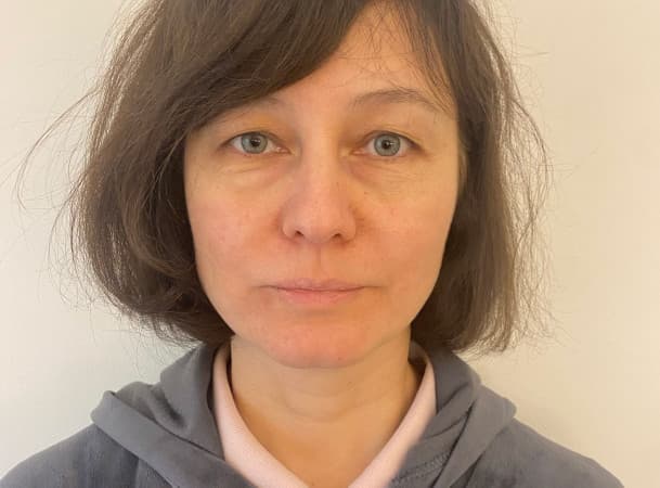 Эндоскопический лифтинг лба, Эндоскопический лифтинг средней зоны лица, Блефаропластика нижних век - До (frontView)