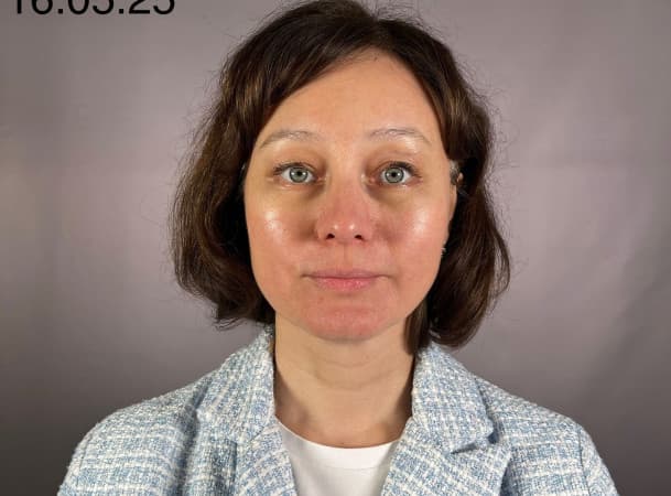 Эндоскопический лифтинг лба, Эндоскопический лифтинг средней зоны лица, Блефаропластика нижних век - После (frontView)