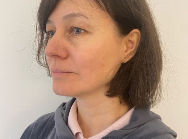 Эндоскопический лифтинг лба, Эндоскопический лифтинг средней зоны лица, Блефаропластика нижних век - До (threeQuarterView)