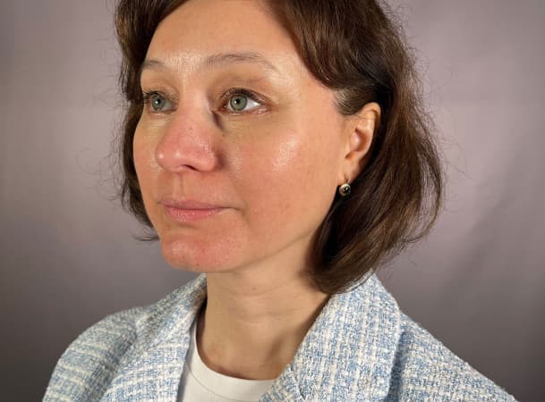 Эндоскопический лифтинг лба, Эндоскопический лифтинг средней зоны лица, Блефаропластика нижних век - После (threeQuarterView)