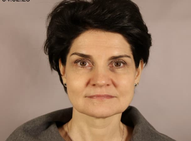 Тотальный лифтинг лица:   Эндоскопический лифтинг лба,  Эндоскопический лифтинг средней зоны лица,  Блефаропластика нижних век,  СМАС-лифтинг лица,  Платизмопластика - До (frontView)