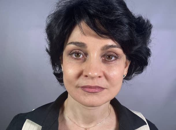 Тотальный лифтинг лица:   Эндоскопический лифтинг лба,  Эндоскопический лифтинг средней зоны лица,  Блефаропластика нижних век,  СМАС-лифтинг лица,  Платизмопластика - После (frontView)