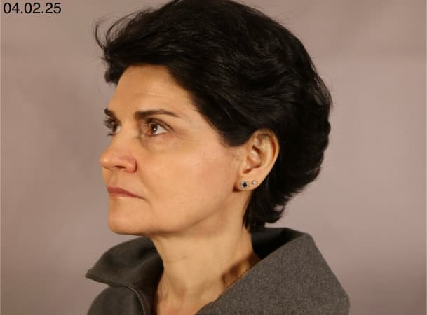 Тотальный лифтинг лица:   Эндоскопический лифтинг лба,  Эндоскопический лифтинг средней зоны лица,  Блефаропластика нижних век,  СМАС-лифтинг лица,  Платизмопластика - До (threeQuarterView)