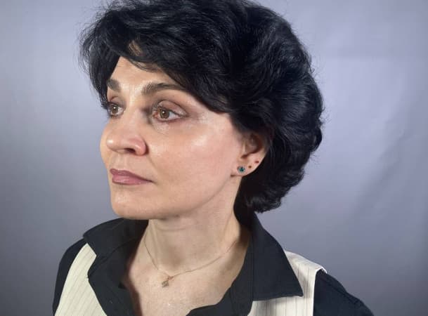 Тотальный лифтинг лица:   Эндоскопический лифтинг лба,  Эндоскопический лифтинг средней зоны лица,  Блефаропластика нижних век,  СМАС-лифтинг лица,  Платизмопластика - После (threeQuarterView)