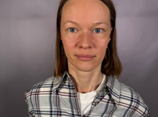 Эндоскопический лифтинг средней зоны лица - После (frontView)