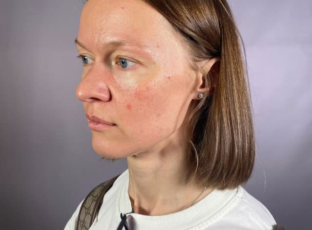 Эндоскопический лифтинг средней зоны лица - До (threeQuarterView)