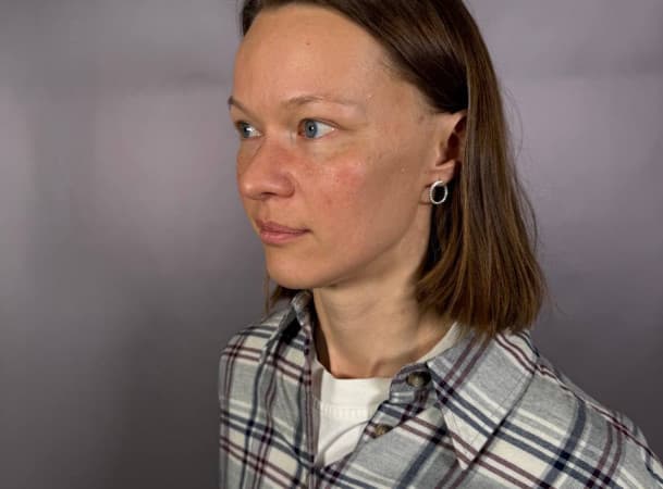 Эндоскопический лифтинг средней зоны лица - После (threeQuarterView)