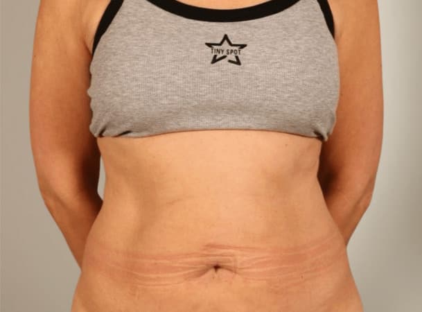 Мини-абдоминопластика, Липосакция живота - до