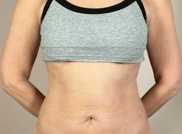 Мини-абдоминопластика, Липосакция живота - после