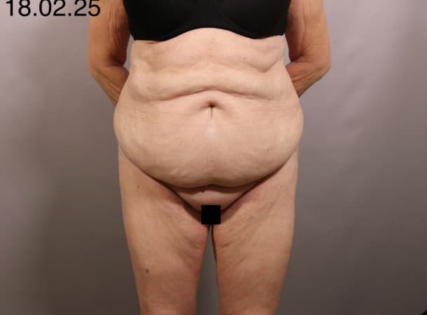 Мини-абдоминопластика, Липосакция - до